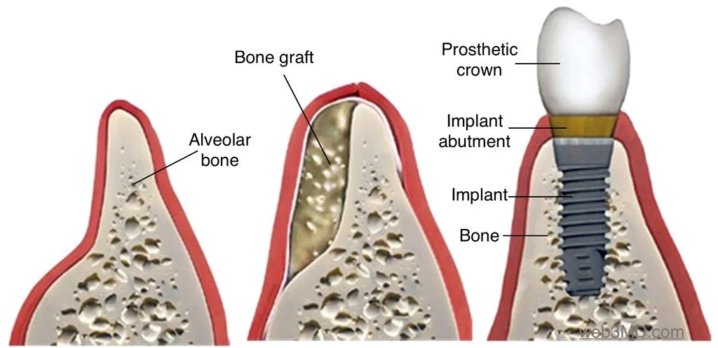 Bone Grafting