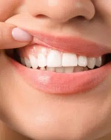 Healthy Gums