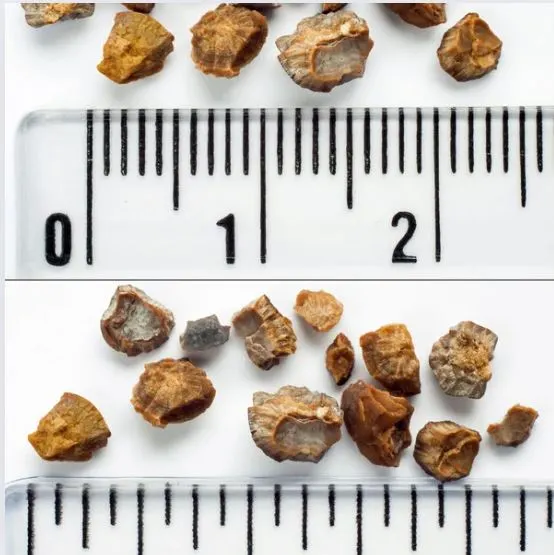 Kidney Stones
