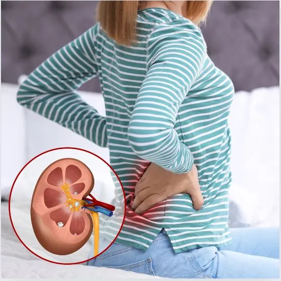 symptoms of idney stones